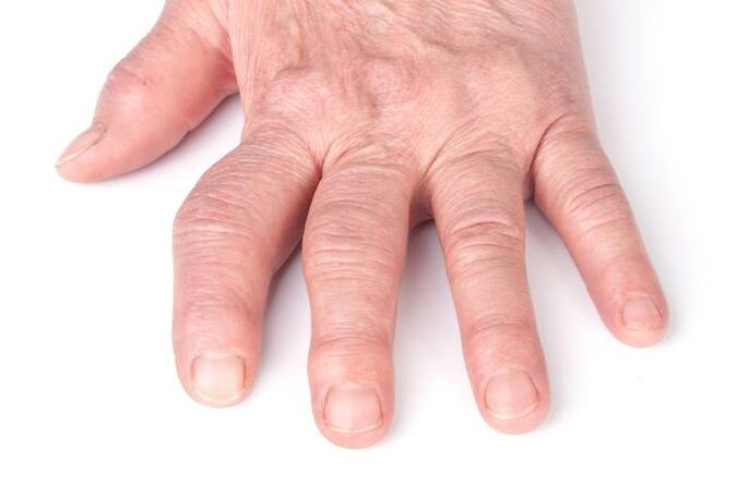 deformuojanti artrozė ant rankų