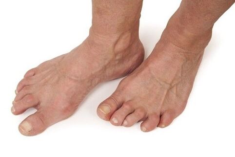 artrozės pažeistos pėdos