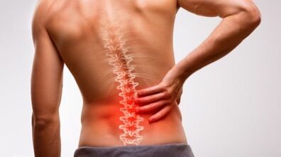 Juosmens stuburo osteochondrozės požymiai ir simptomai