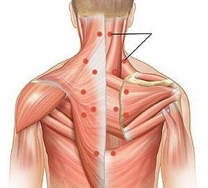 miozitas kaip nugaros skausmo priežastis