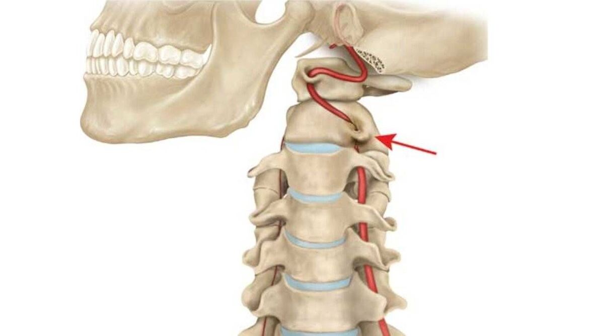 kaklo stuburo osteochondrozė