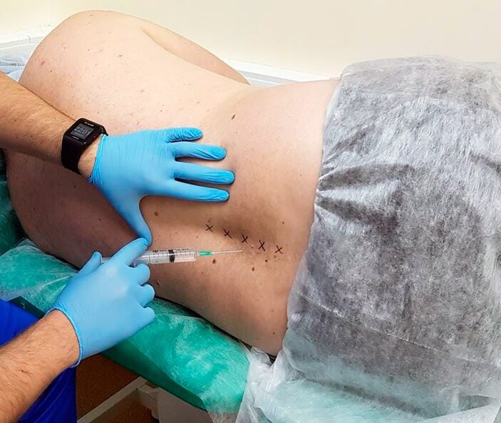 medicininės blokados nugarai