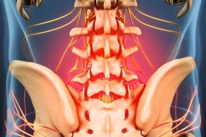 osteochondrozės priežastys ir simptomai