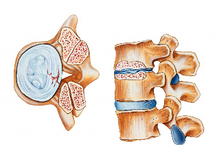 Osteochondrozė