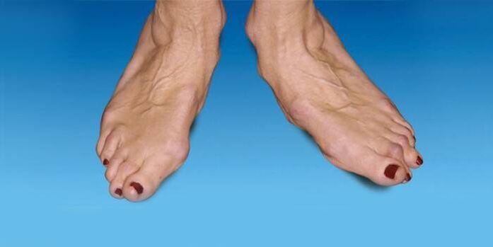 pėdos deformacija su kulkšnies artroze