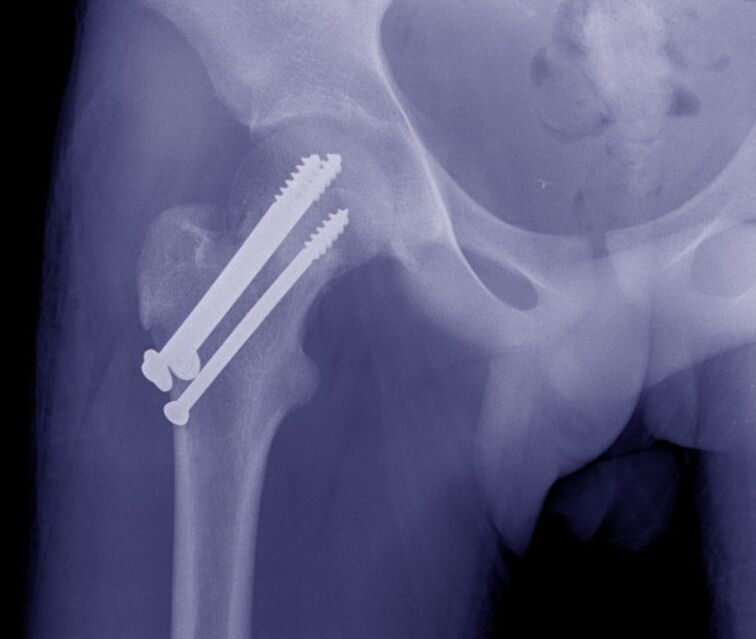 Klubo sąnario rentgeno nuotrauka, lūžio osteosintezė su vidiniais fiksavimo įtaisais